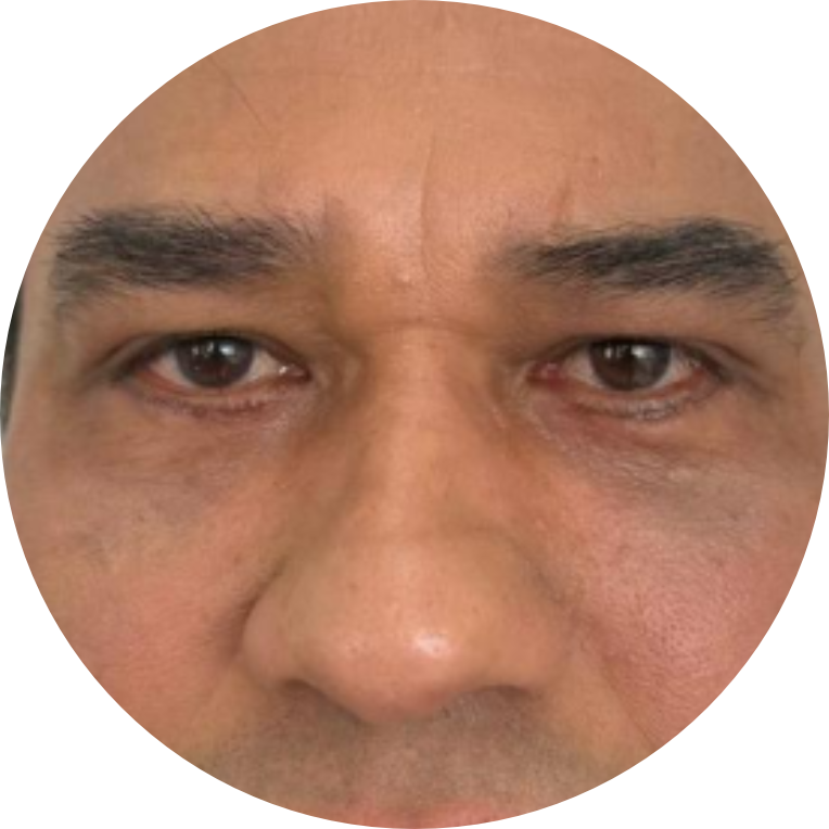 Resultado Real - Tratamiento de Ojeras Masculino