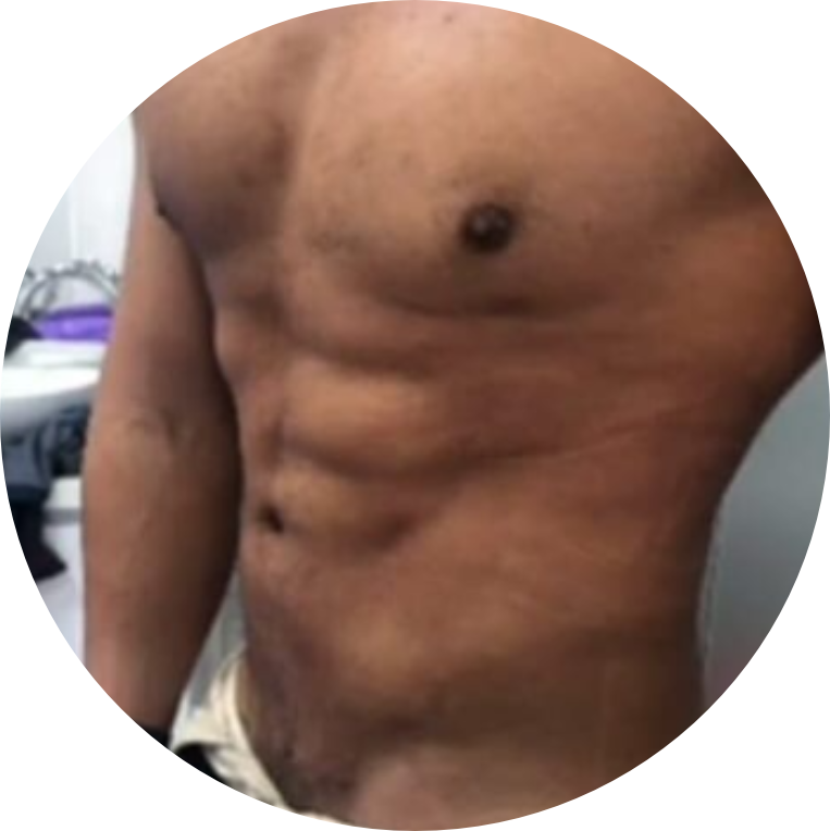 Resultado Real - Marcación Abdominal Vaser