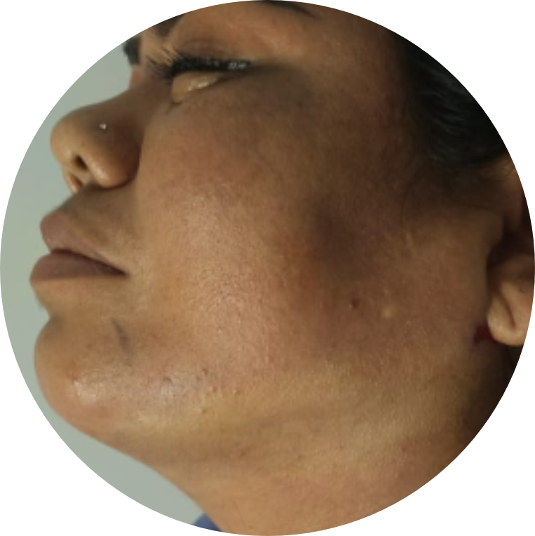 Resultado Real - Lipopapada Vaser