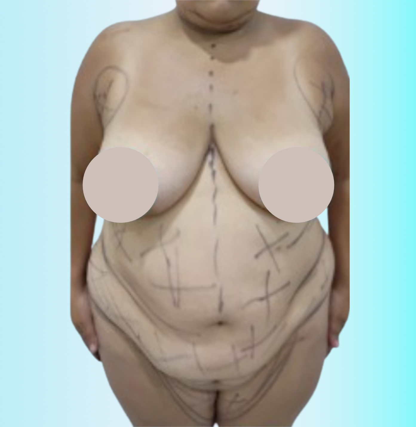 Lipoescultura VASER Antes