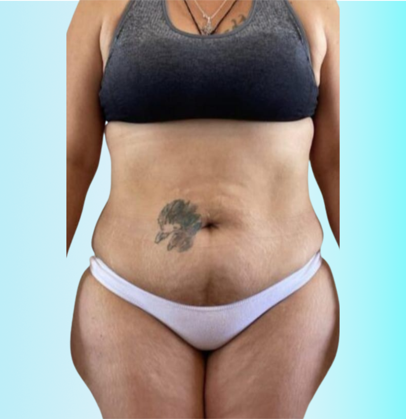 Lipo de Brazos Antes