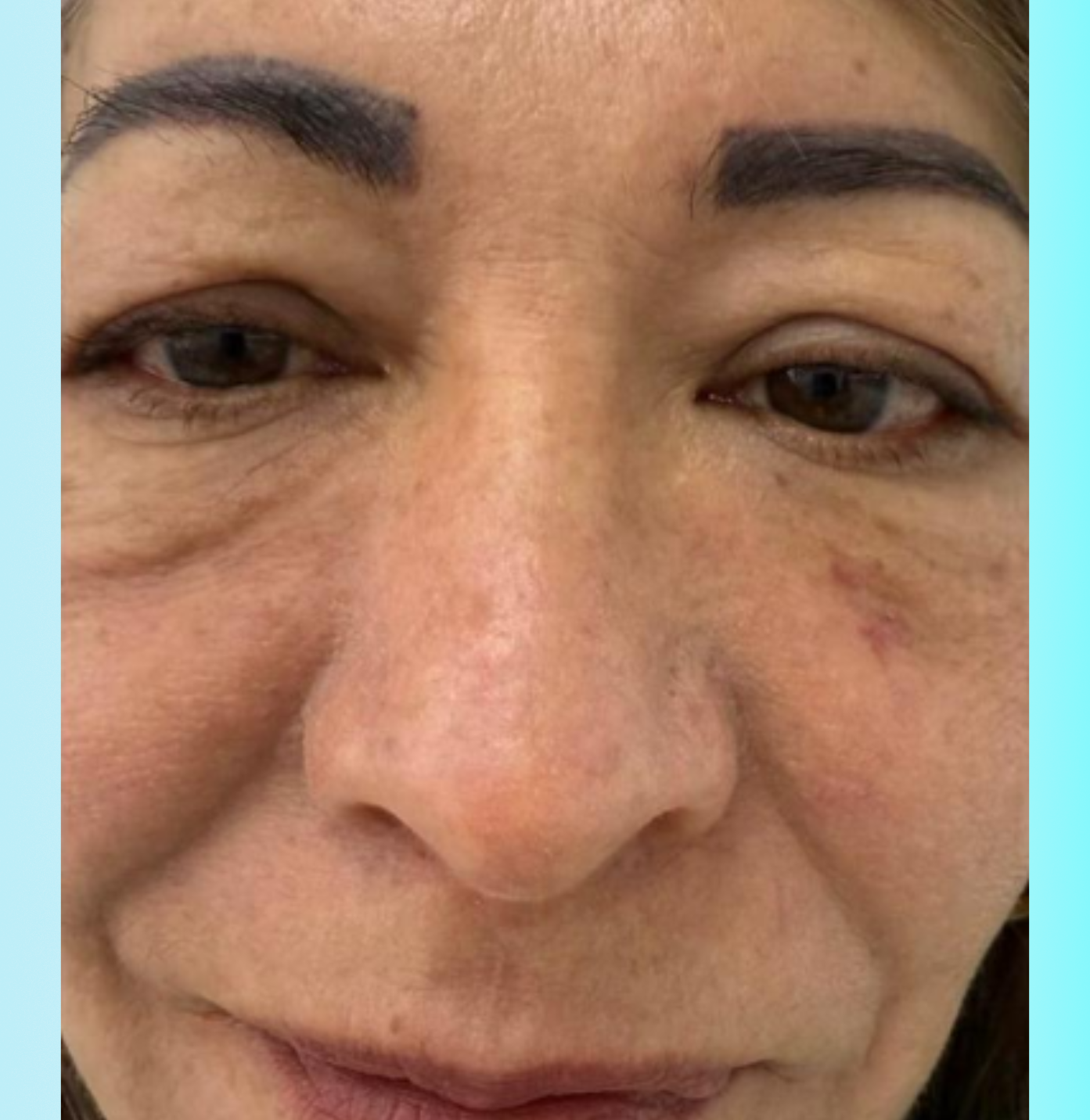 Bioestimuladores Antes