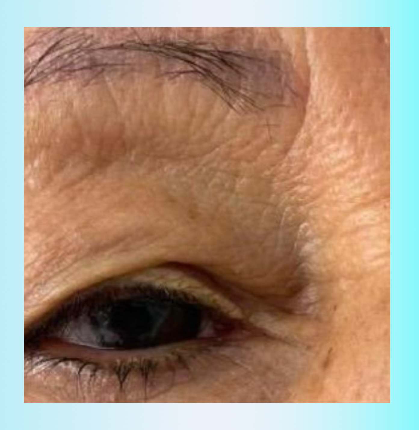 Toxina Botulínica Antes