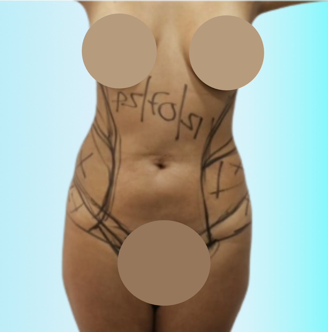 Rinomodelación Antes