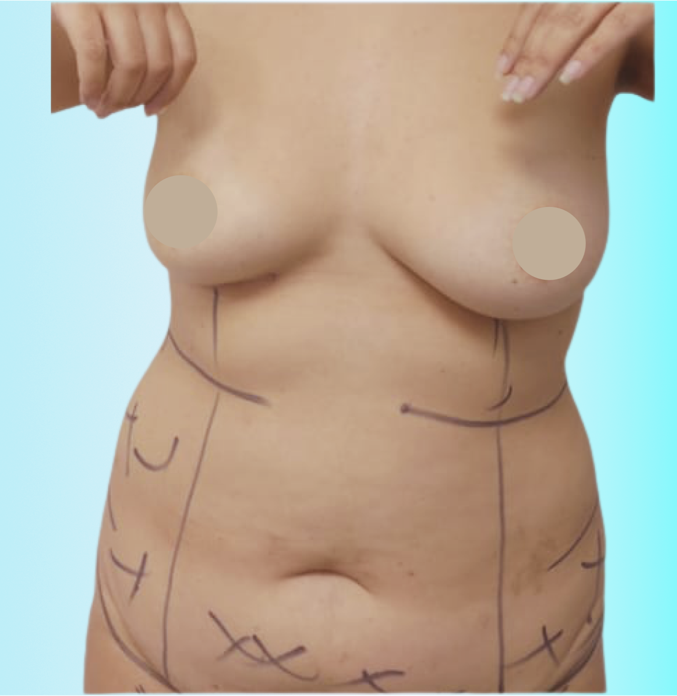 Lipotransferencia Antes