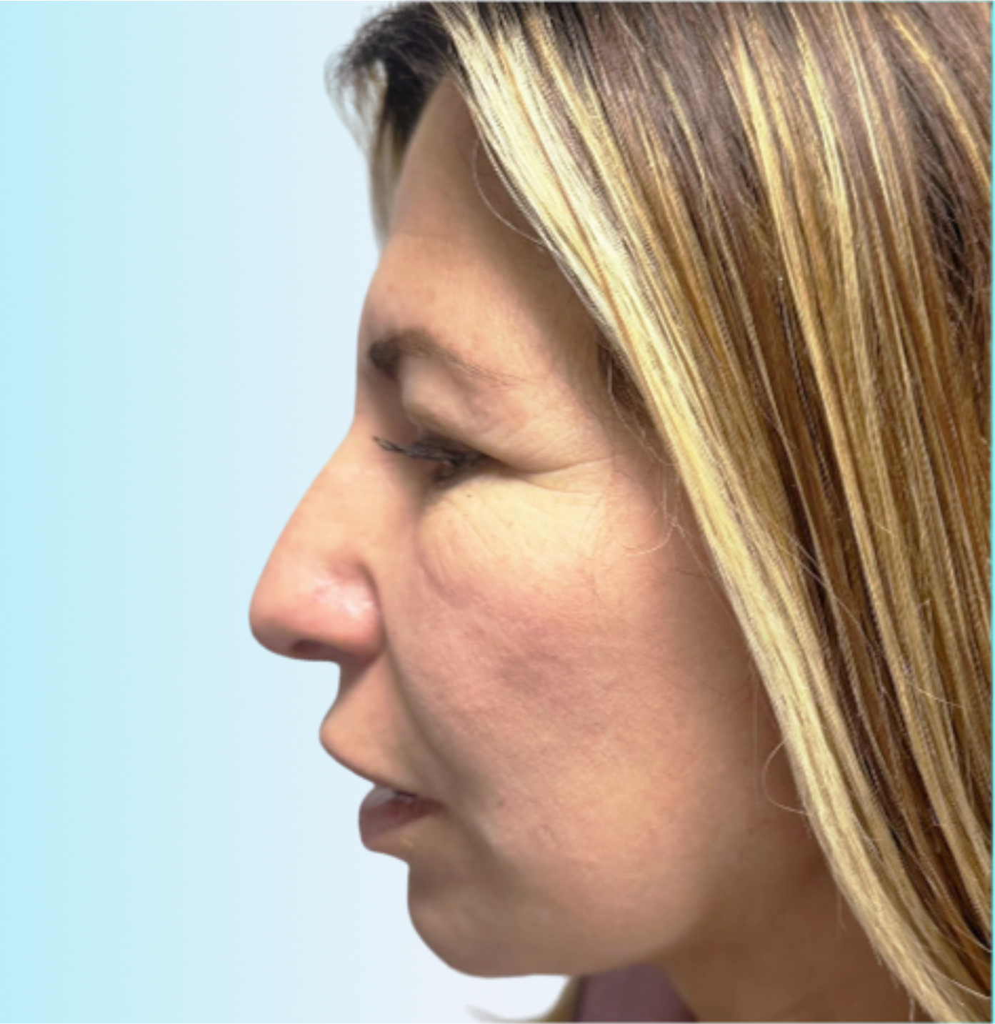 Marcación Mandibular Antes