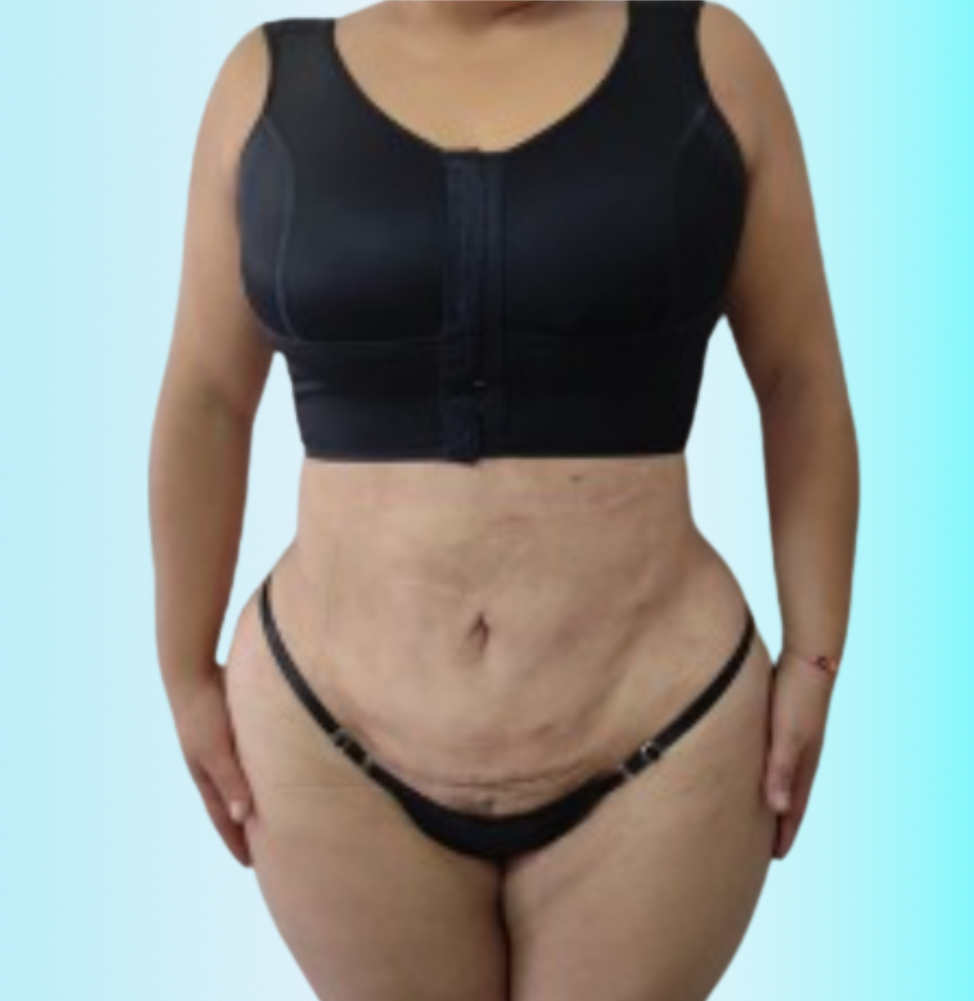 Lipoescultura VASER Despues