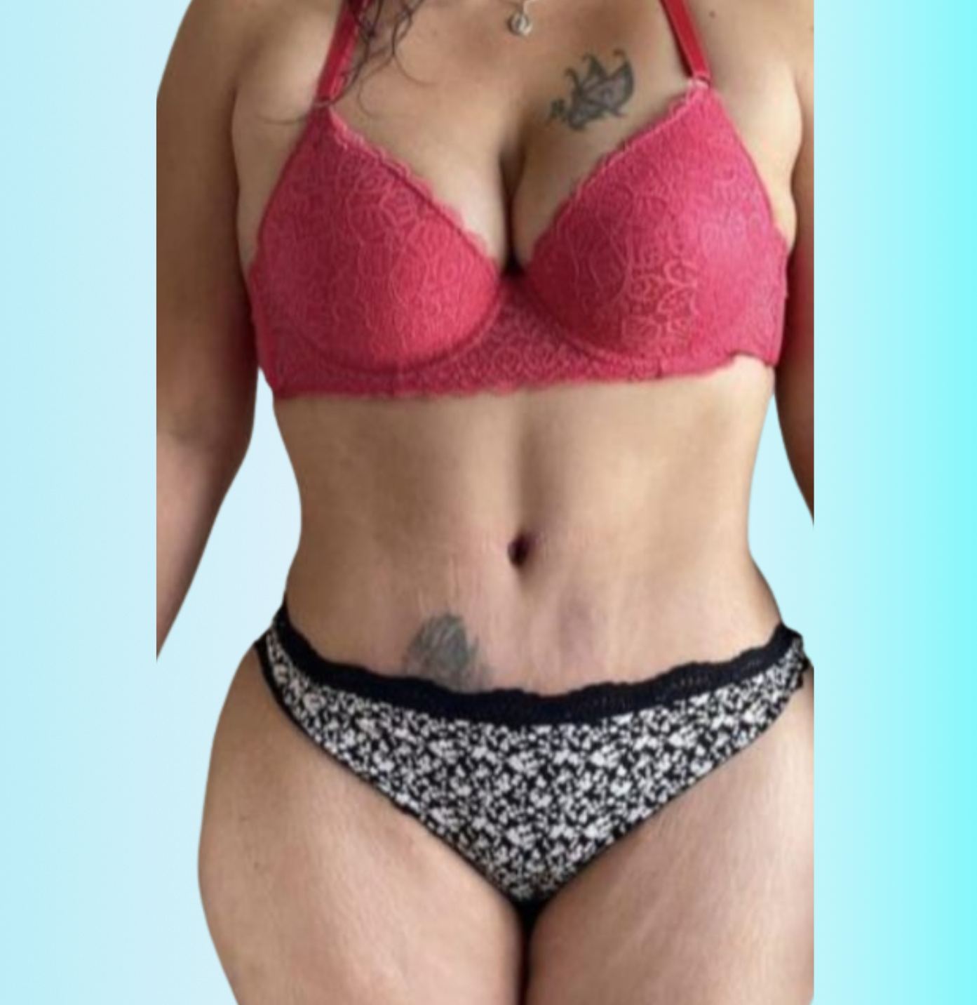 Lipo de Brazos Despues