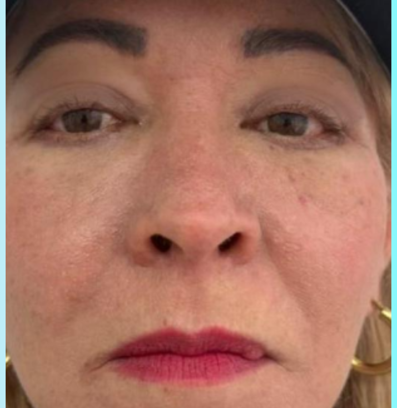 Bioestimuladores Despues