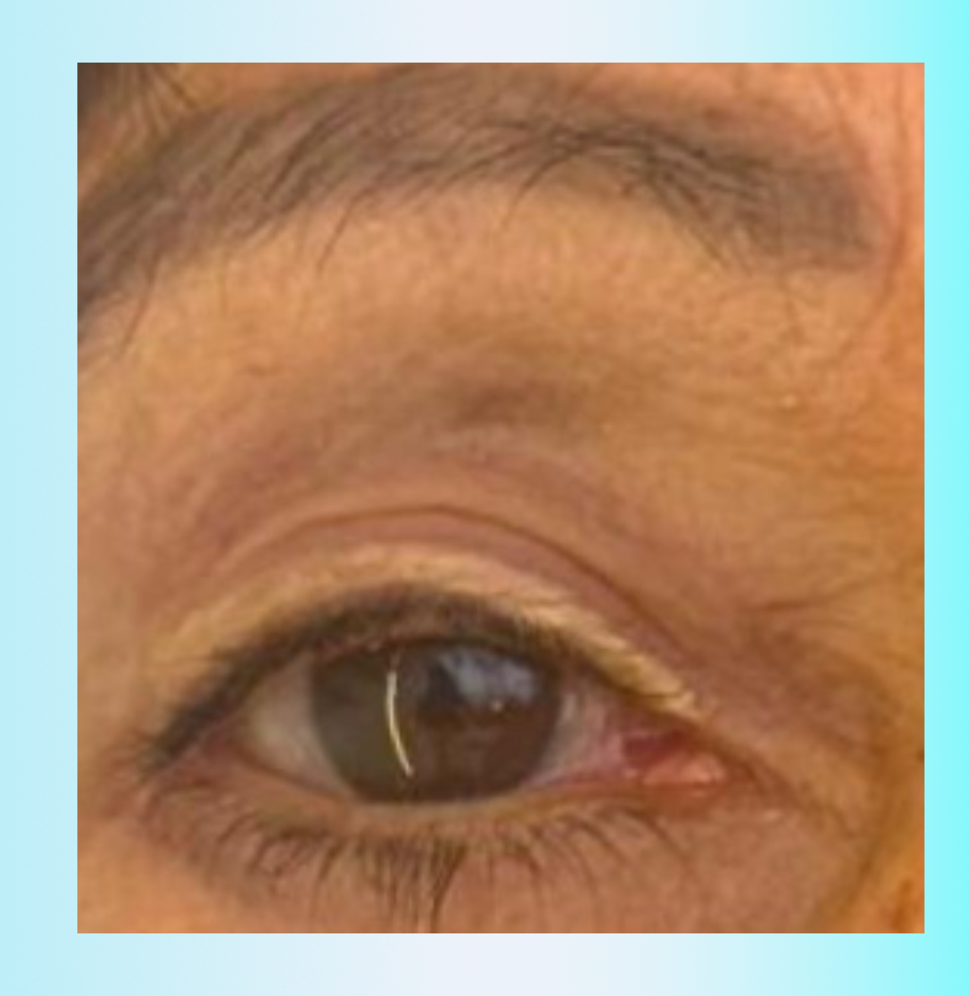 Toxina Botulínica Despues