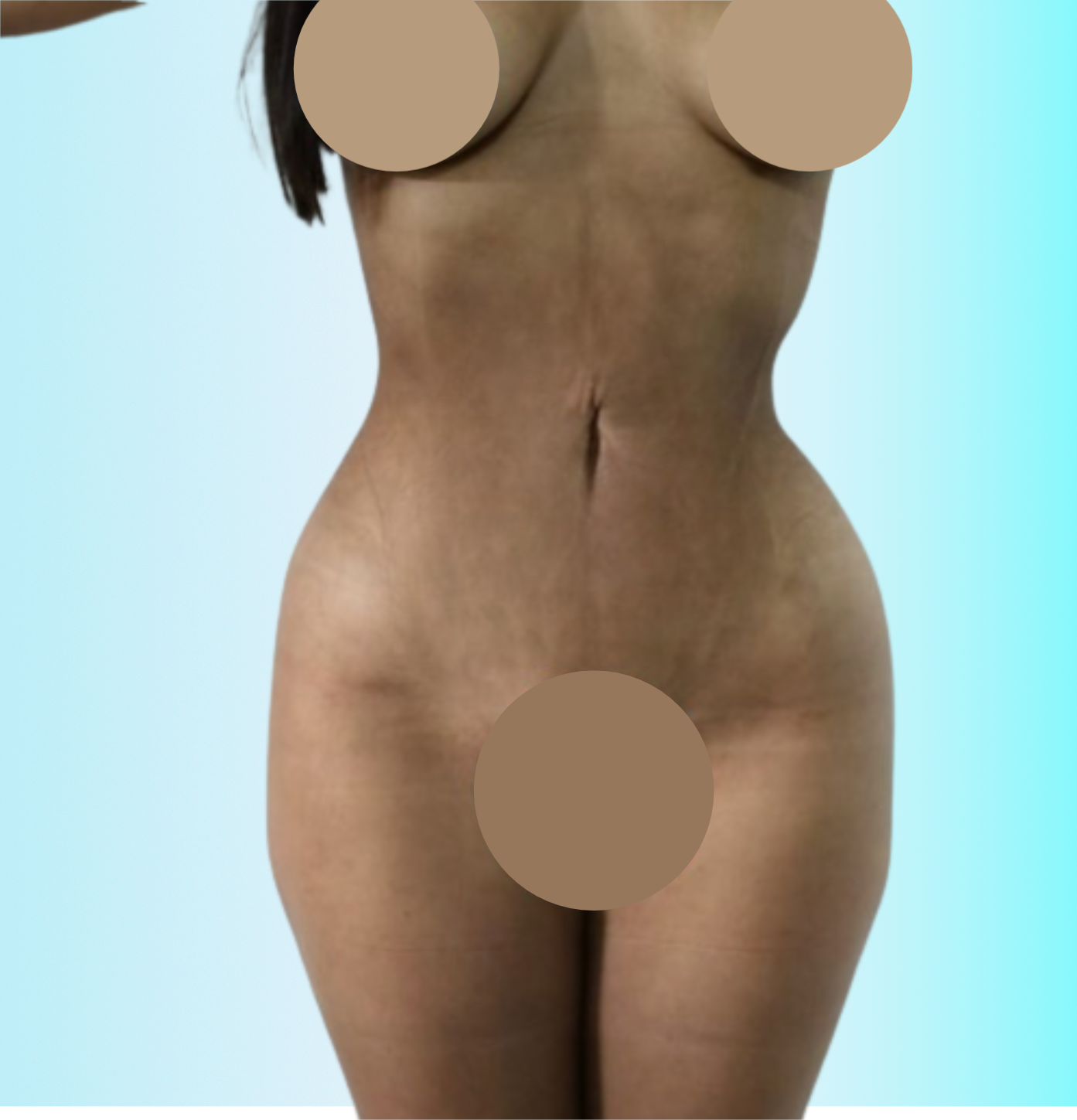 Rinomodelación Despues