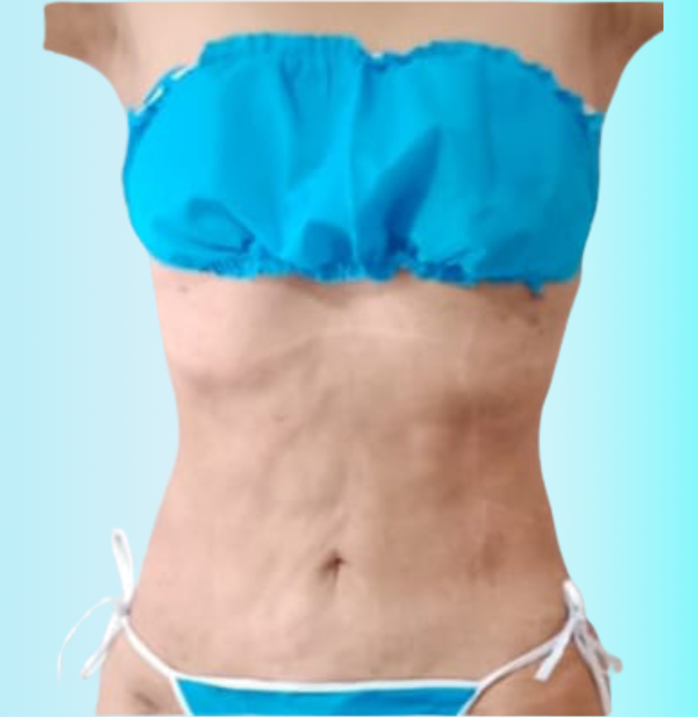 Lipotransferencia Despues