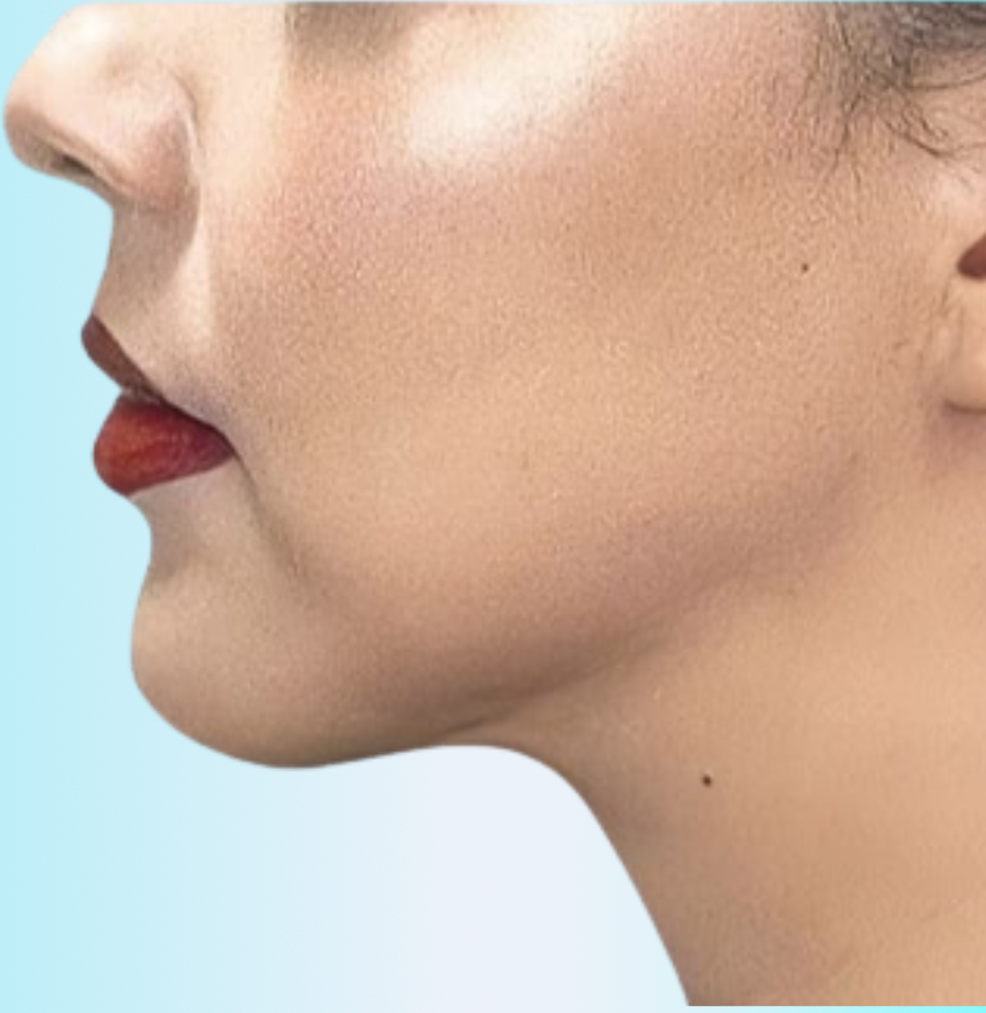 Armonización Despues