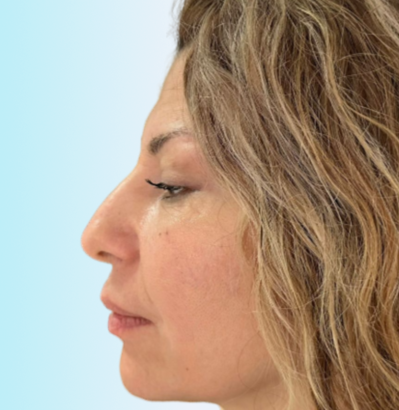 Marcación Mandibular Despues